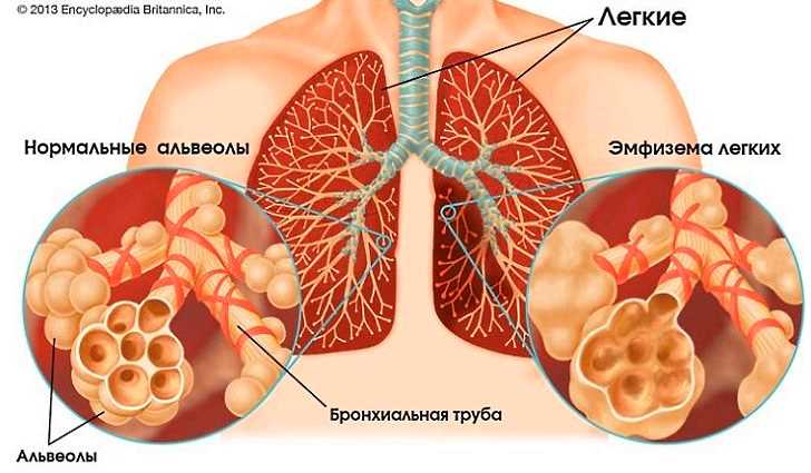 Эмфизема легких симптомы причины